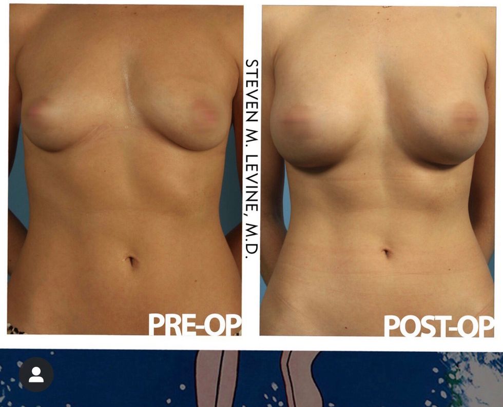 everything to know about breast augmentation surgery