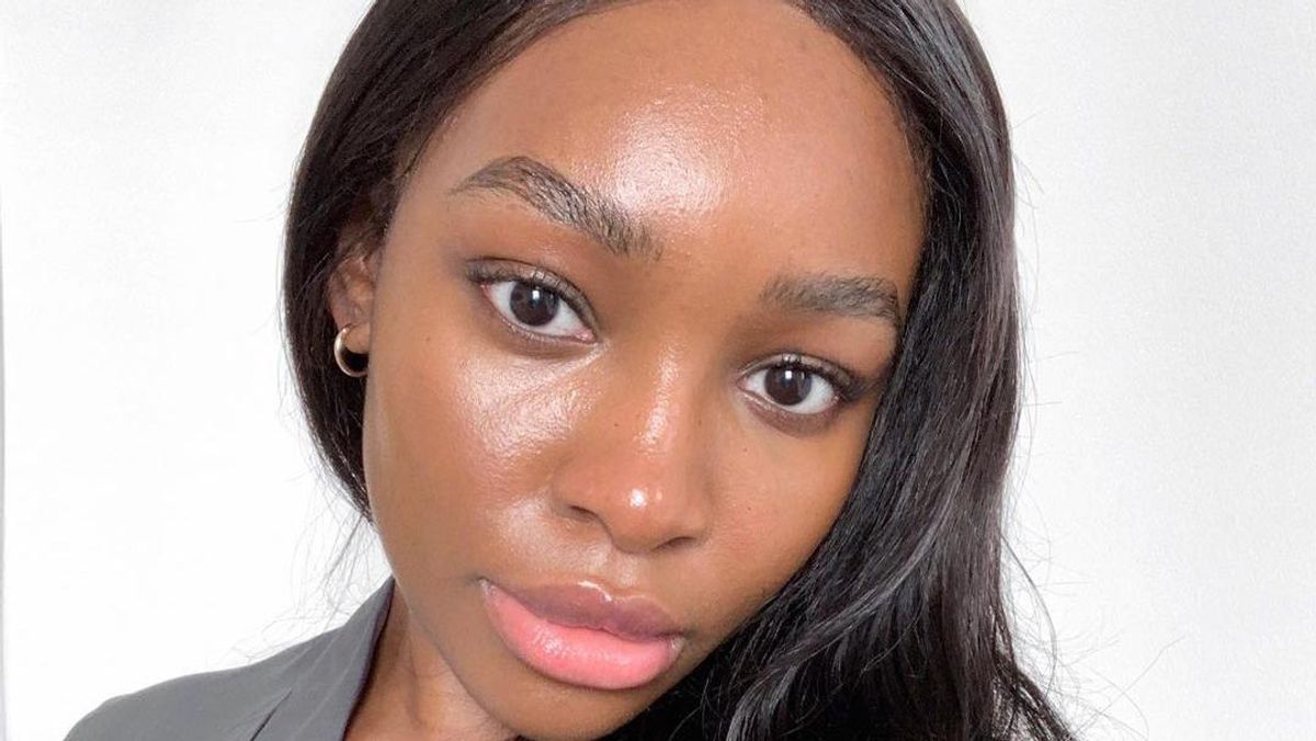 hyperpigmentation
