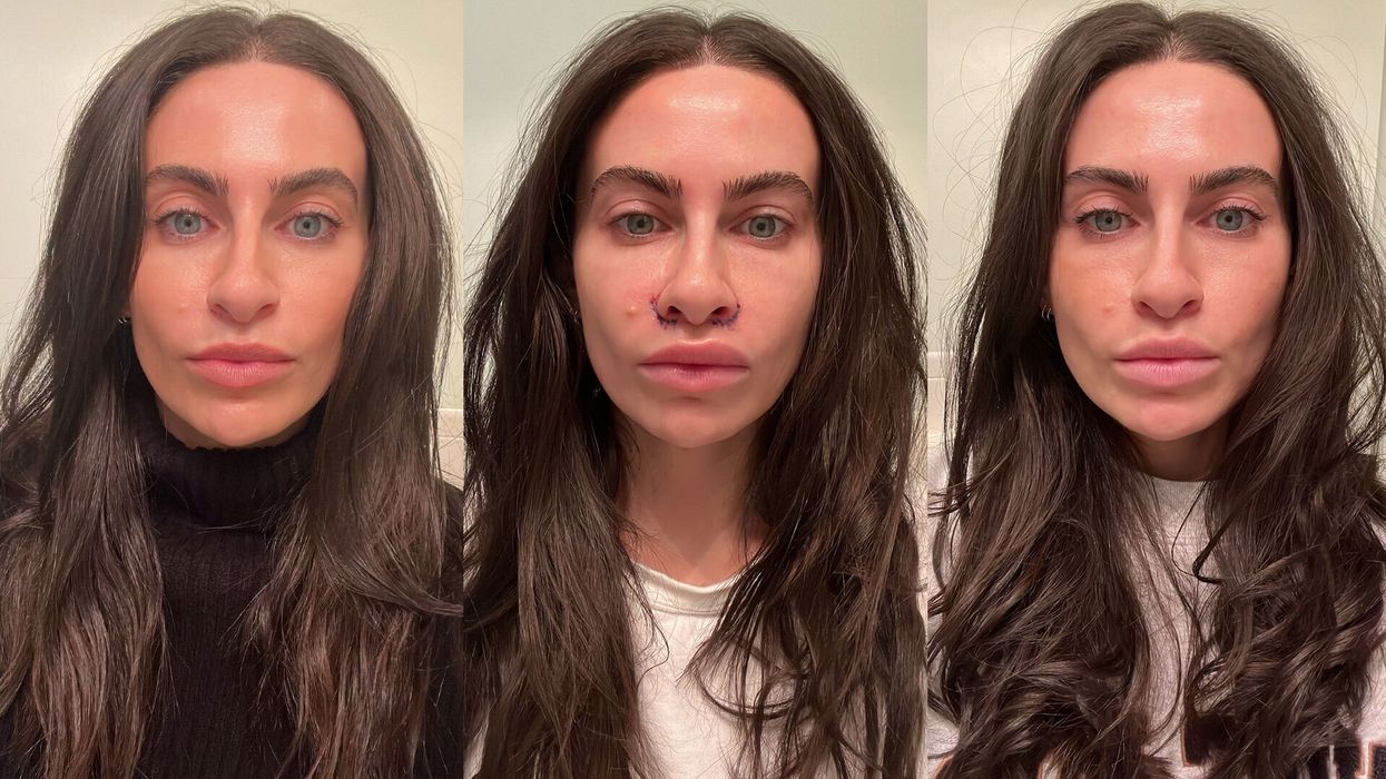 I Got a Lip Lift and Didn’t Love the Results — So I Went Back Under the Knife Again